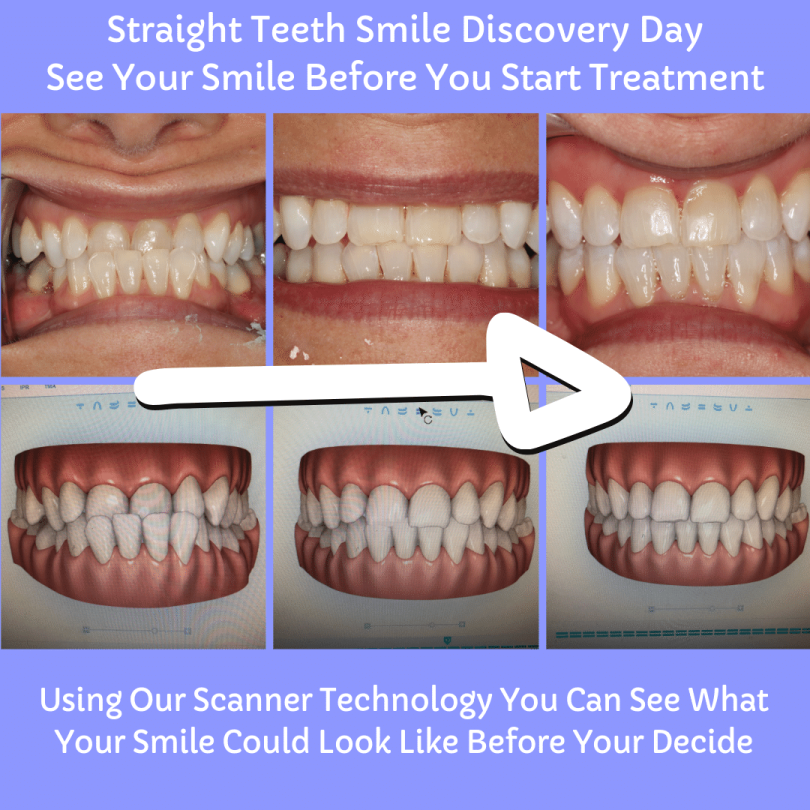 Straight Teeth Smile Discovery Day