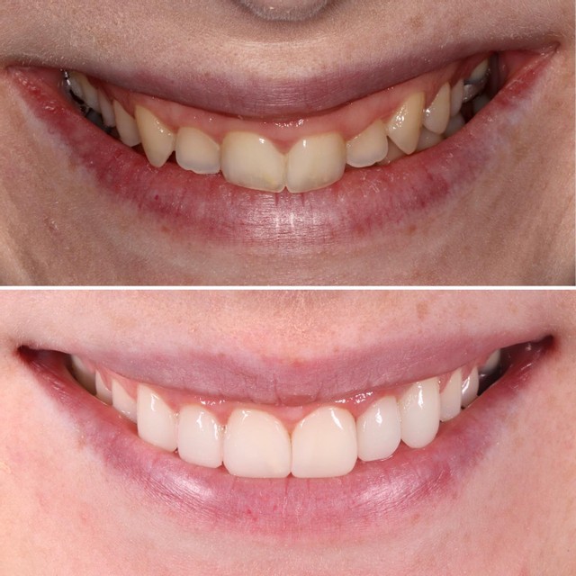 Invisalign To Align And Level The Teeth And The Gums   Tooth Whitening   Gum Contouring To Further Level The Gums   Composite Bonding On The Front 6 Teeth