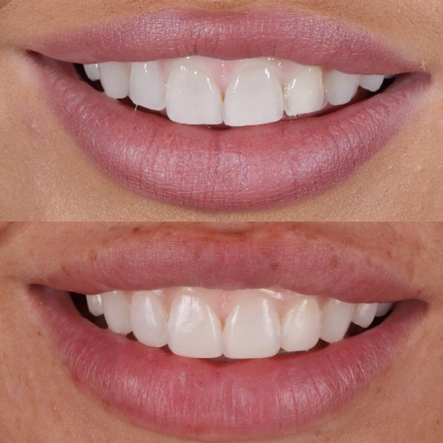 Tooth Whitening And Composite Bonding