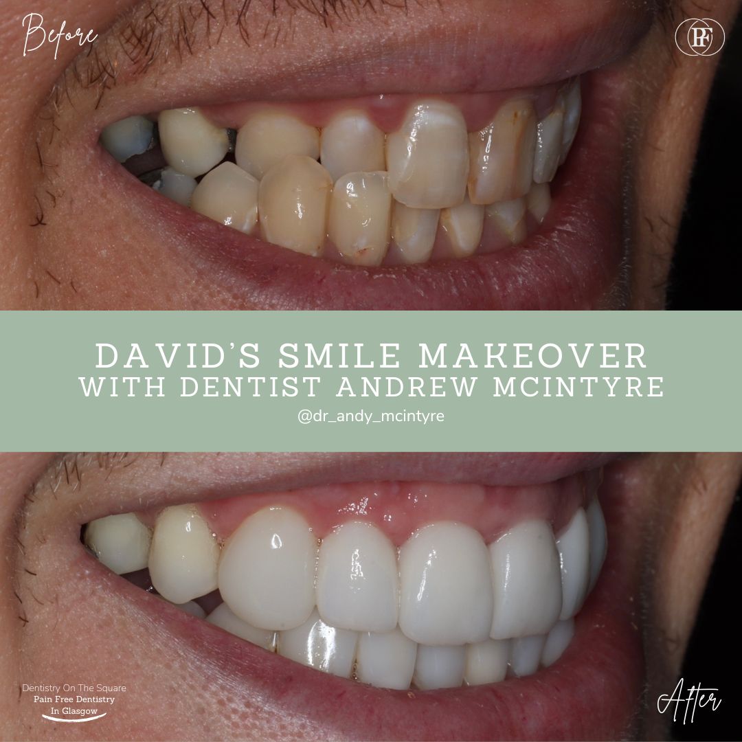 Dentistry On The Square, Pain Free Dentist Glasgow - Smile Makeovers in Glasgow Smile Makeover Transformation with Andy