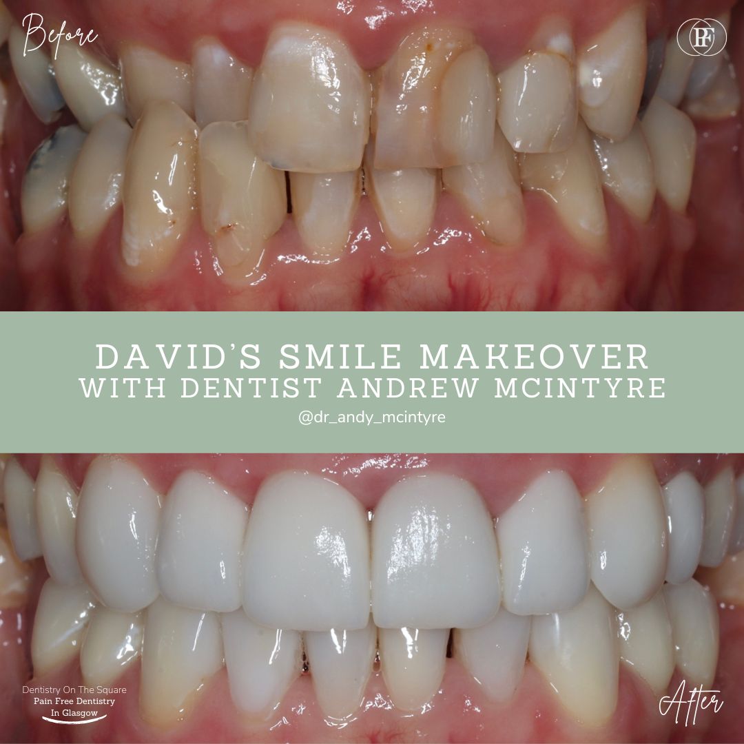 Dentistry On The Square, Pain Free Dentist Glasgow - Smile Makeovers in Glasgow David's Smile Makeover with Andy
