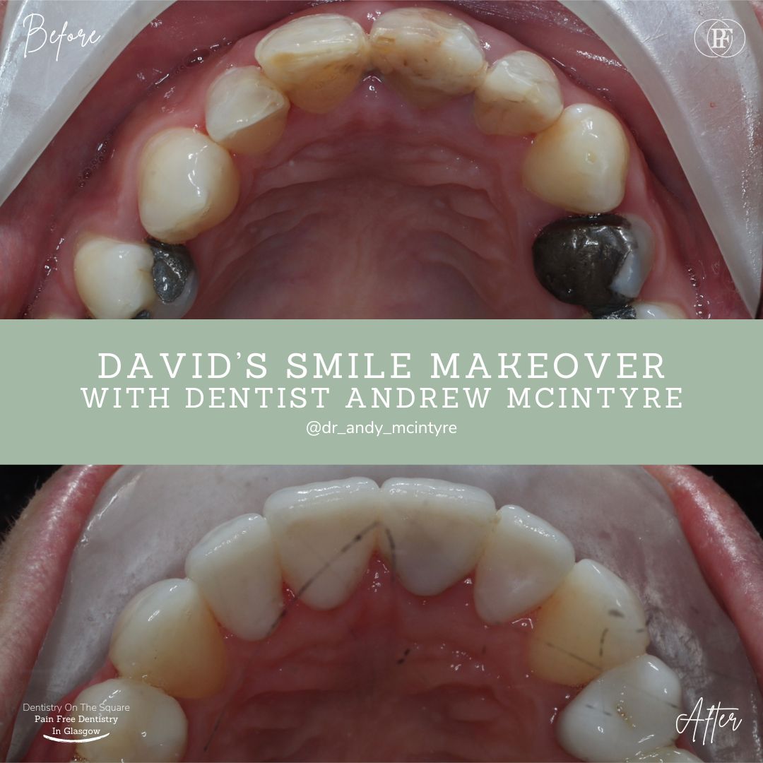 Dentistry On The Square, Pain Free Dentist Glasgow - Smile Makeovers in Glasgow Smile Makeover Transformation with Andy