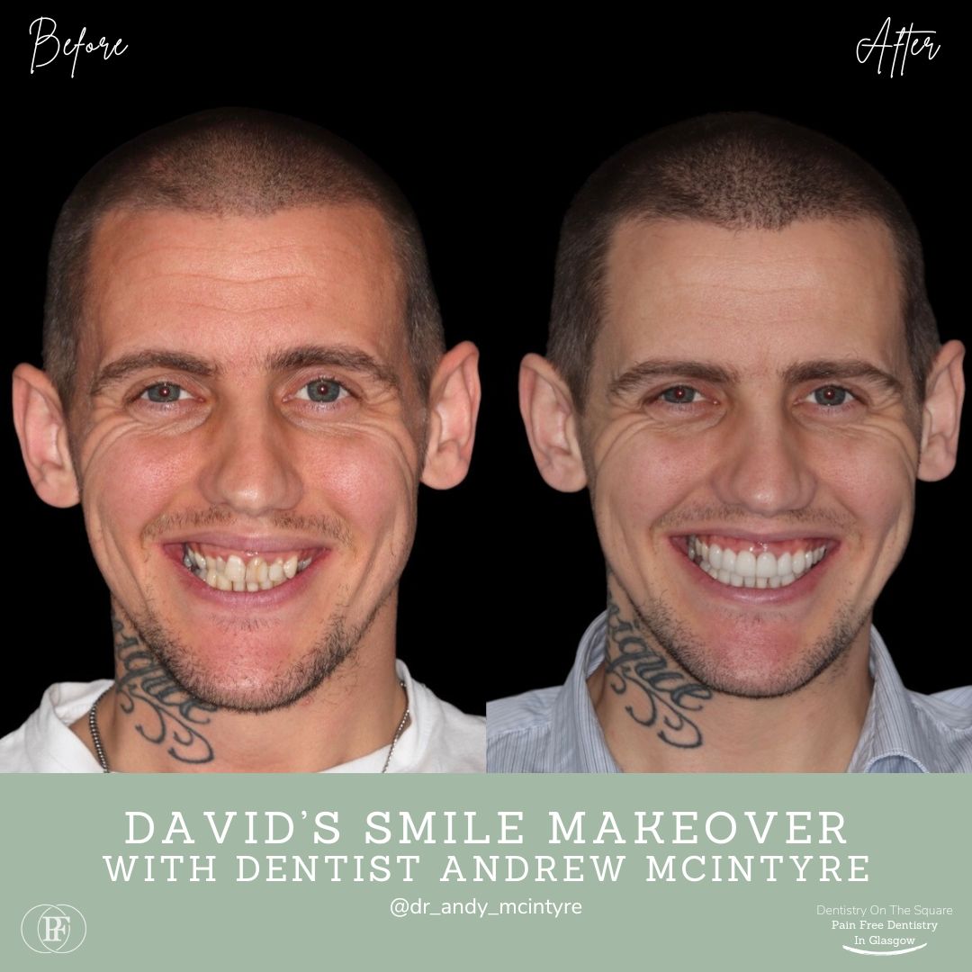 Dentistry On The Square, Pain Free Dentist Glasgow - Smile Makeovers in Glasgow Smile Makeover Transformation with Andy