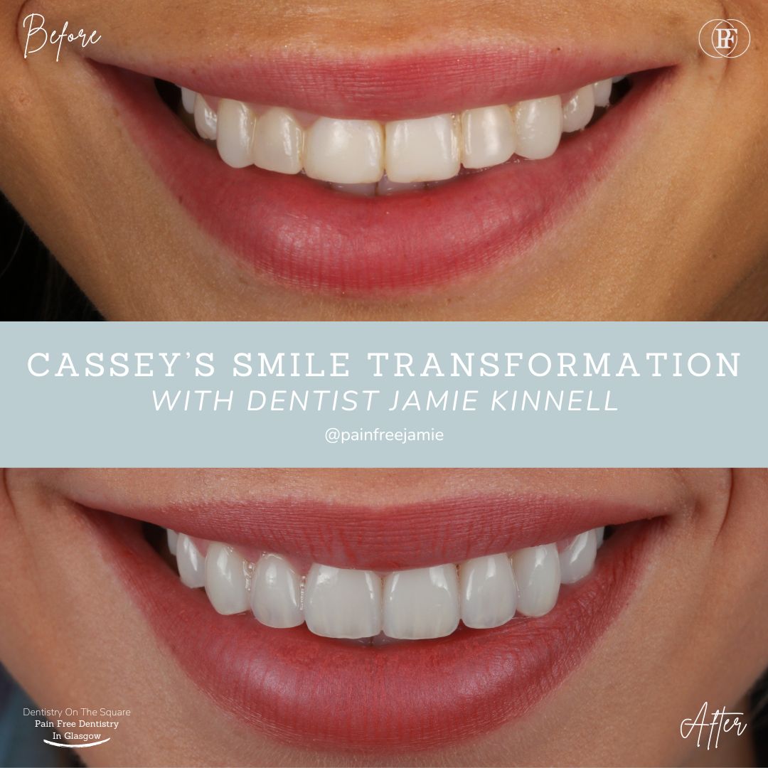 Dentistry On The Square, Pain Free Dentist Glasgow - Smile Makeovers in Glasgow Smile Makeover Transformation with Jamie
