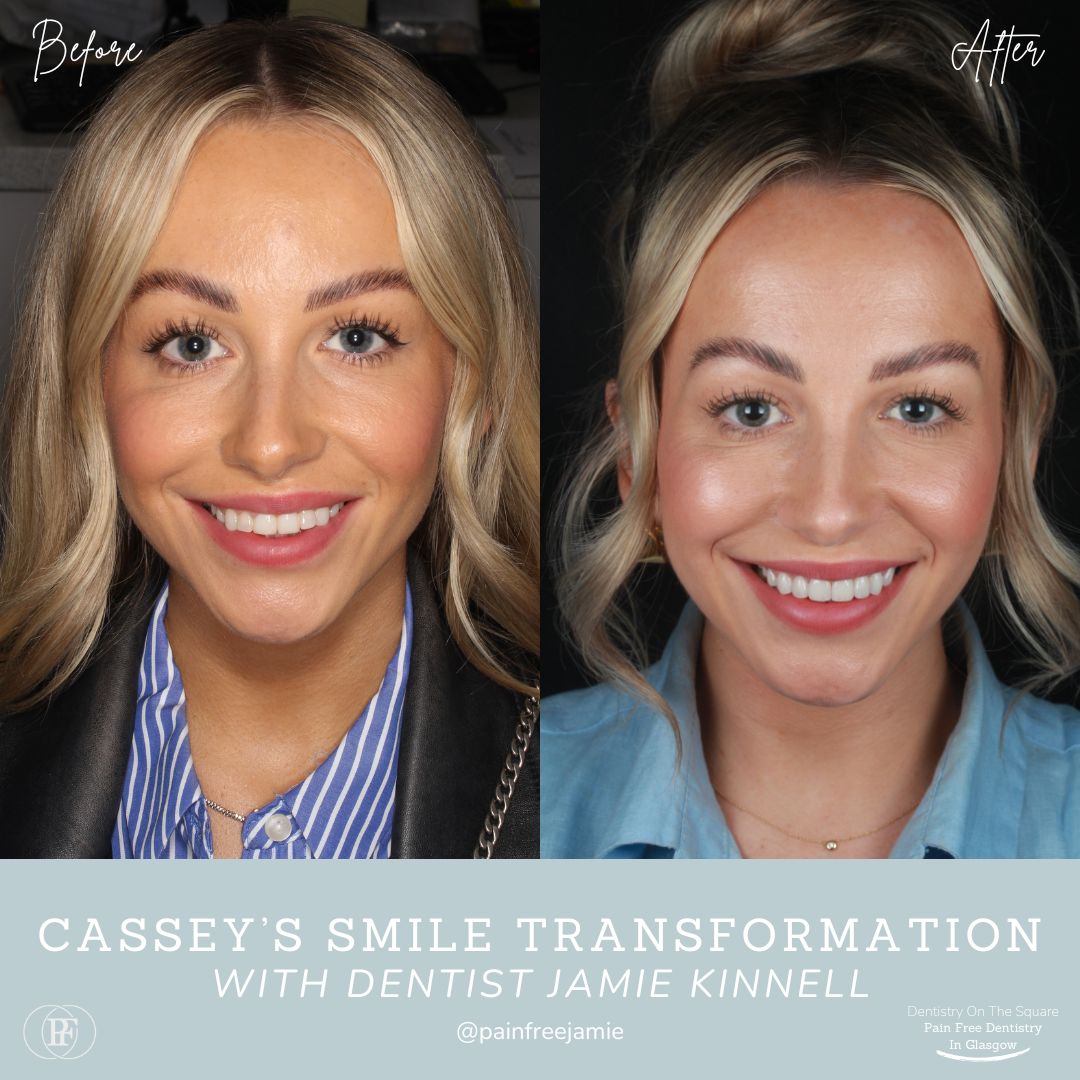 Dentistry On The Square, Pain Free Dentist Glasgow - Smile Makeovers in Glasgow Smile Makeover Transformation with Jamie