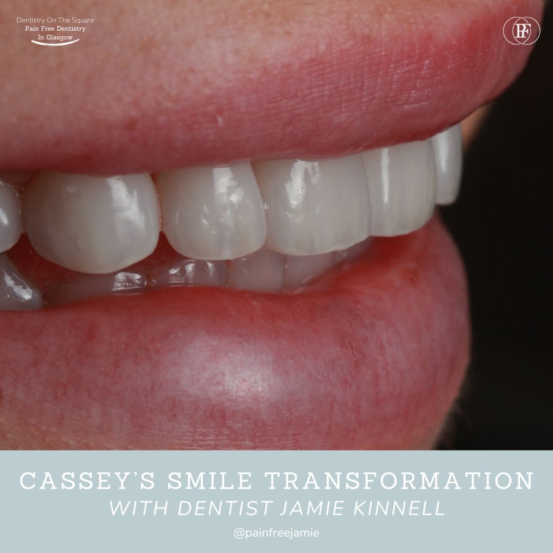Dentistry On The Square, Pain Free Dentist Glasgow - Smile Makeovers in Glasgow Smile Makeover Transformation with Jamie